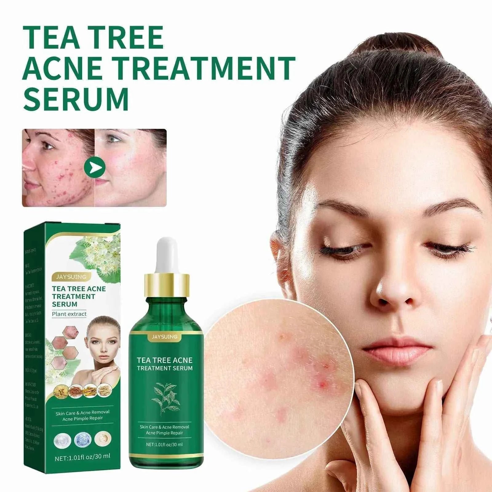 Tea Tree Oil Acne essence Attenuates Acne Print Facial