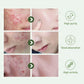 Tea Tree Oil Acne essence Attenuates Acne Print Facial