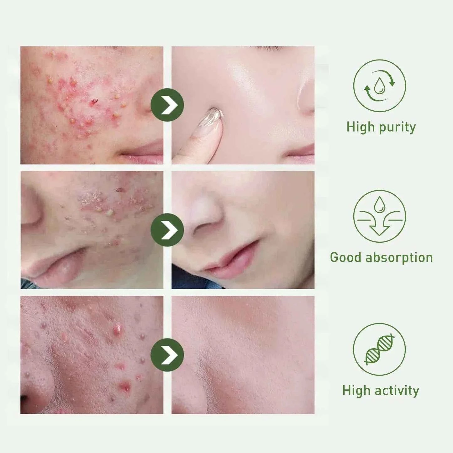 Tea Tree Oil Acne essence Attenuates Acne Print Facial