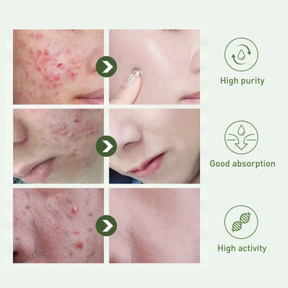 Tea Tree Oil Acne essence Attenuates Acne Print Facial fastdrop shop