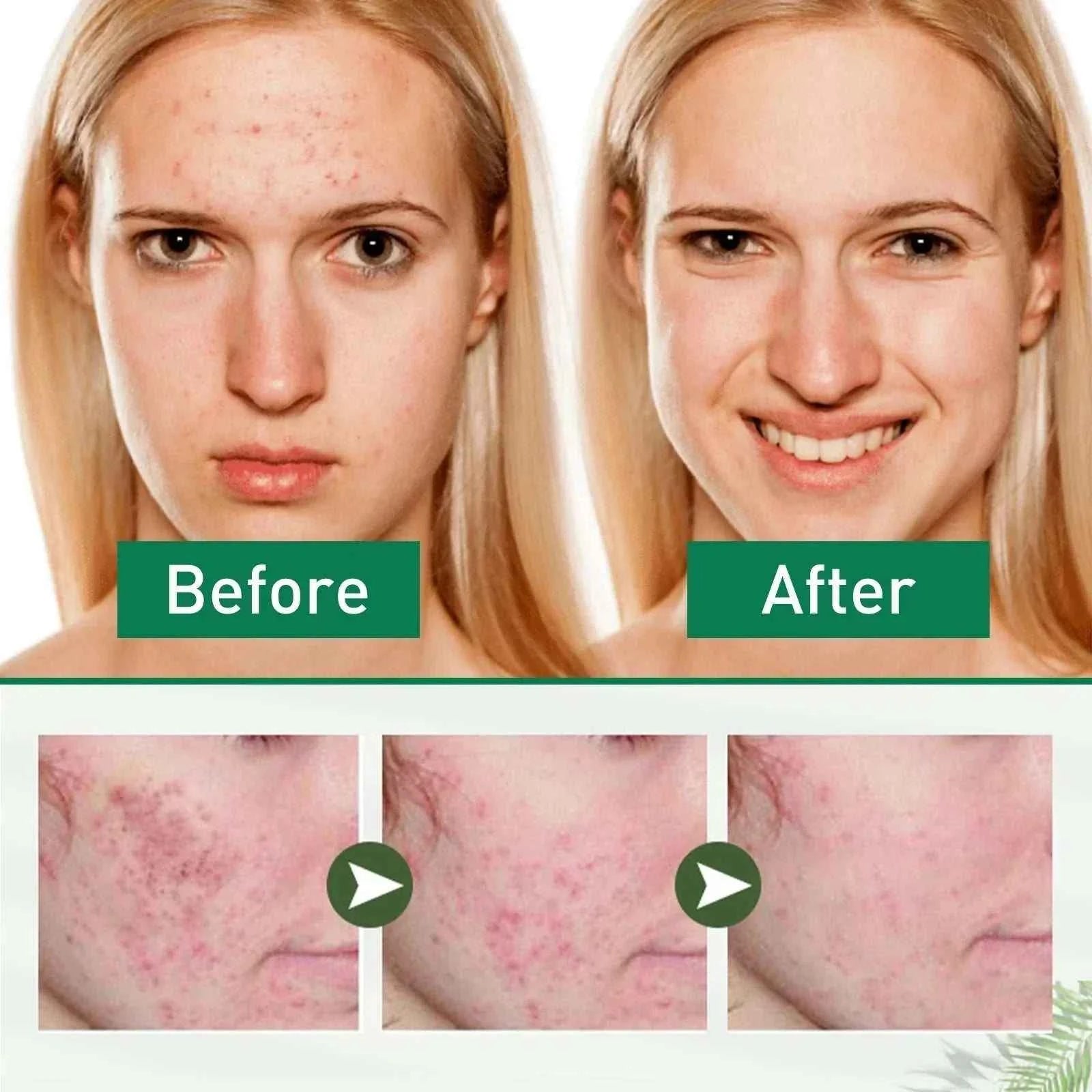 Tea Tree Oil Acne essence Attenuates Acne Print Facial