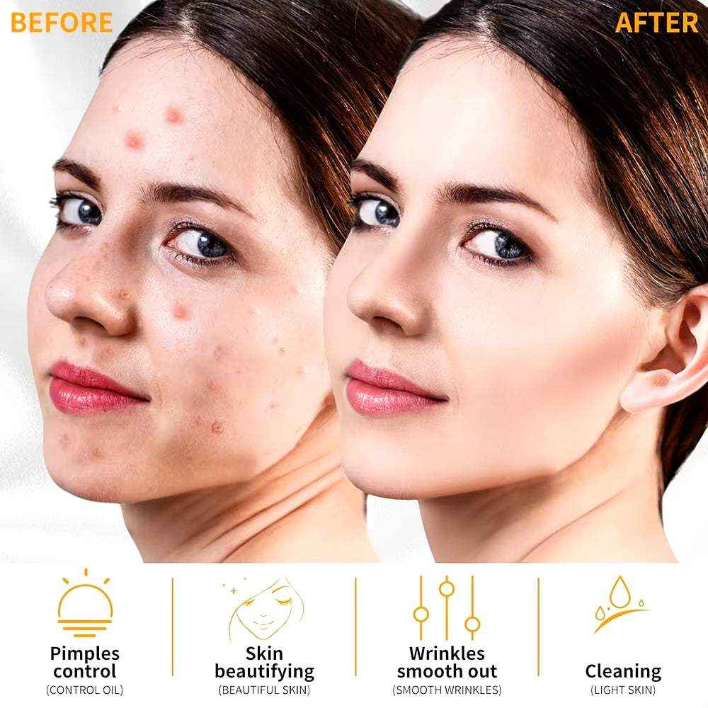 High Frequency Electrotherapy Neon Facial Skin