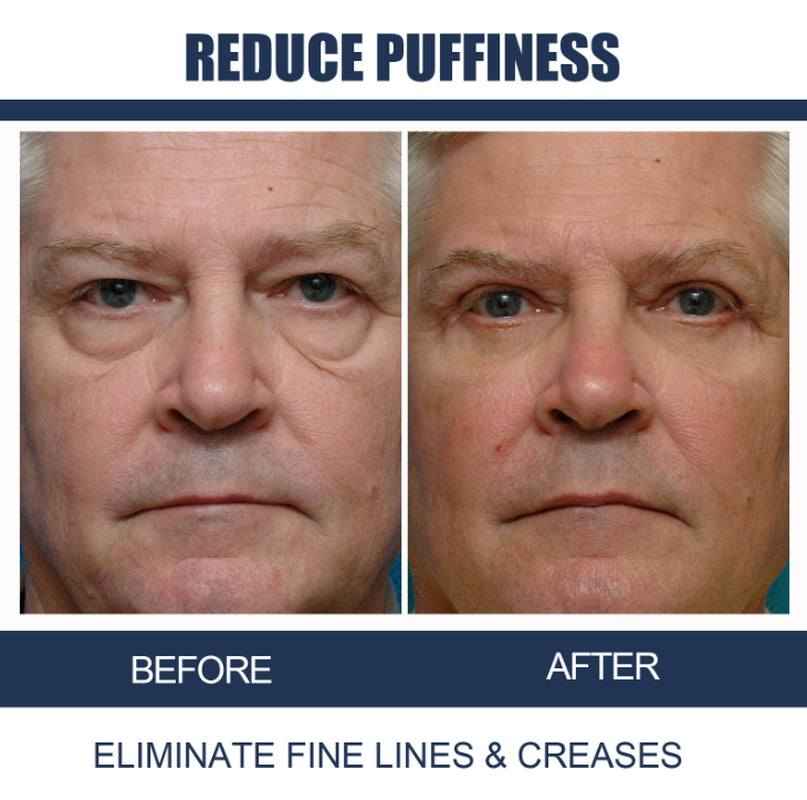 OPENEYES Awaken Lifting Eye Gel （1+1 Buy One Get One Free）
